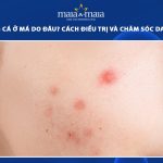 mụn trứng cá ở má