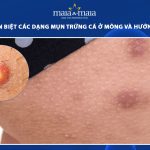 mụn trứng cá ở mông