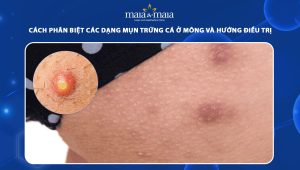 mụn trứng cá ở mông