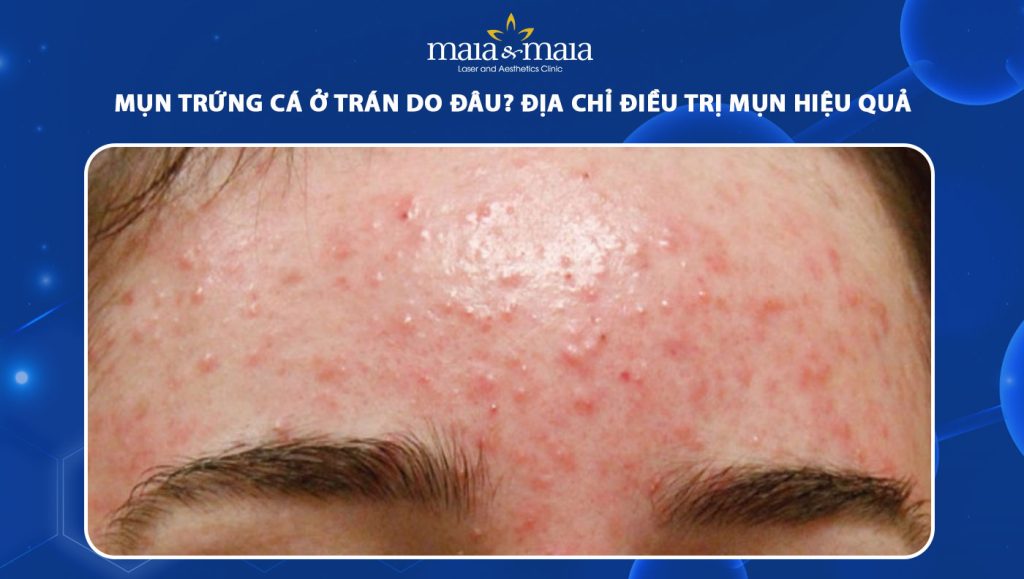 mụn trứng cá ở trán