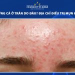 mụn trứng cá ở trán