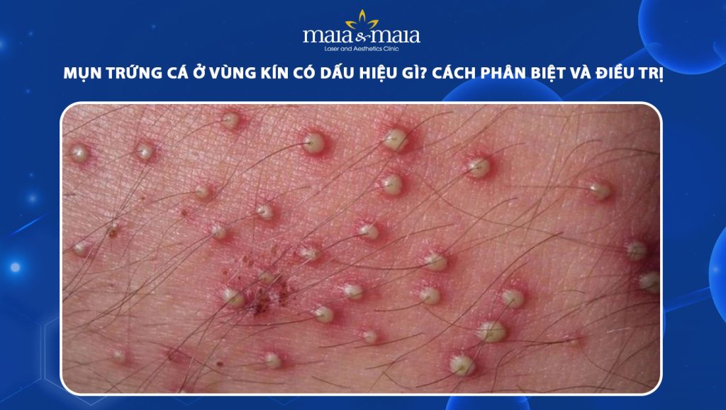 Mụn trứng cá ở vùng kín có dấu hiệu gì? Cách phân biệt và điều trị 1 mụn trứng cá ở vùng kín