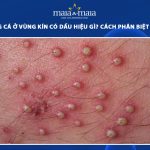 mụn trứng cá ở vùng kín