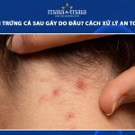 mụn trứng cá sau gáy