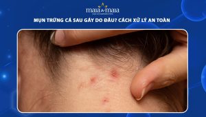 mụn trứng cá sau gáy