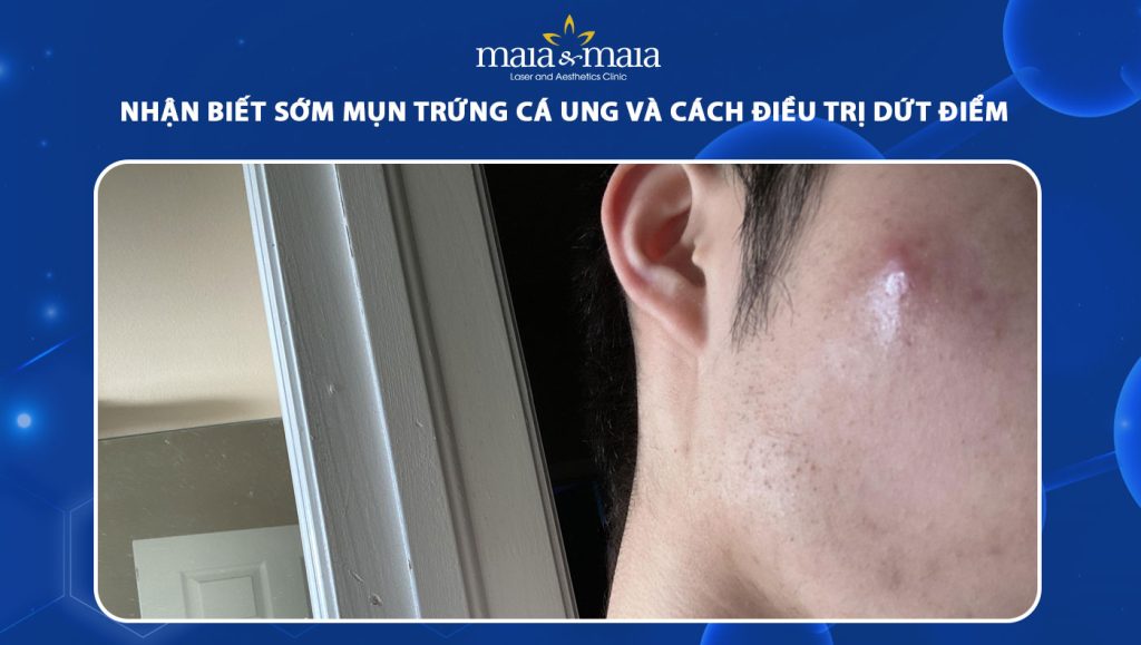 Nhận biết sớm mụn trứng cá ung và cách điều trị dứt điểm 1 mụn trứng cá ung