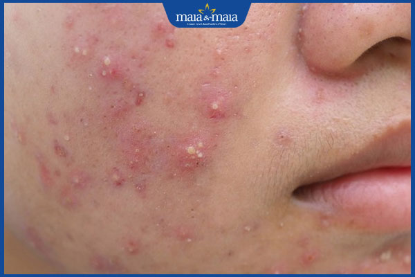 Mụn trứng cá ở má do đâu? Cách điều trị và chăm sóc da 2 mụn viêm gây sẹo