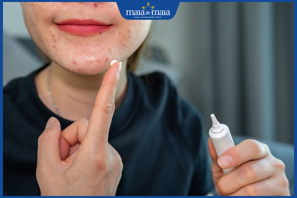 Nặn mụn trứng cá xong bôi gì để da nhanh lành, không thâm sẹo? 3 mỹ phẩm hương liệu