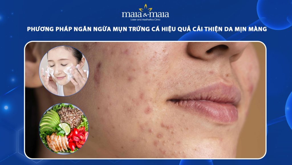 Phương pháp ngăn ngừa mụn trứng cá hiệu quả cải thiện da mịn màng 1 ngăn ngừa mụn trứng cá