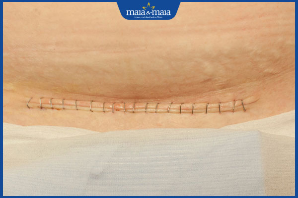 Sẹo mổ đẻ có tự mờ không? Gợi ý điều trị hiệu quả 2 nguyên nhân hình thành sẹo mổ đẻ