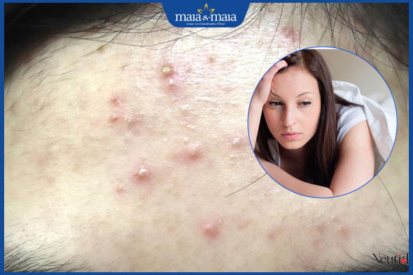 nguyên nhân mụn trán