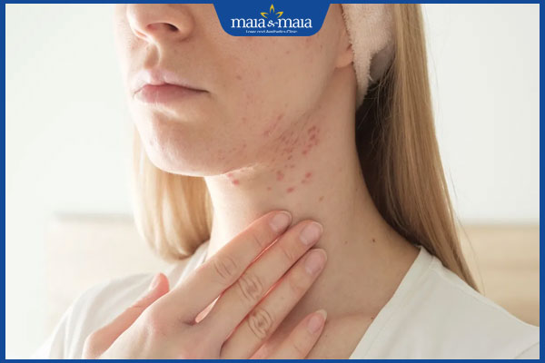 Mụn trứng cá khi mang thai: Nguyên nhân và cách điều trị an toàn cho mẹ bầu 2 nổi mụn khi mang thai