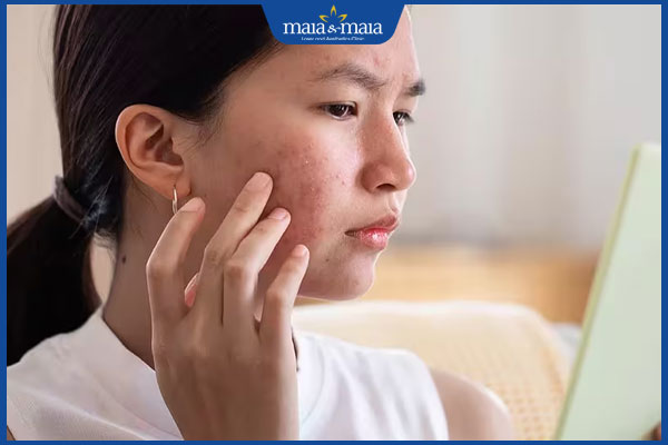 Nổi mụn trứng cá do thuốc có dấu hiệu gì? Cách xử lý an toàn 2 nổi mụn trứng cá do thuốc