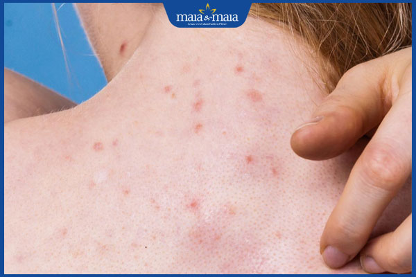 nổi mụn trứng cá sau gáy