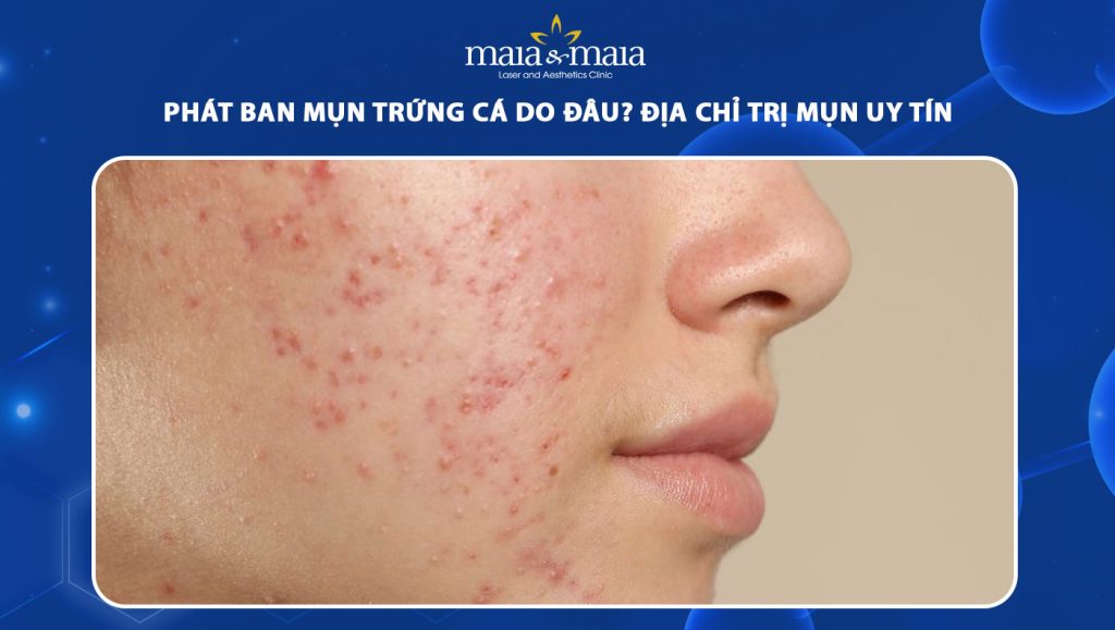 phát ban mụn trứng cá