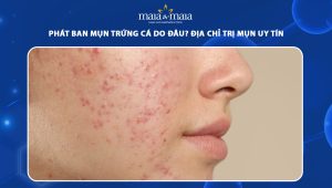 phát ban mụn trứng cá