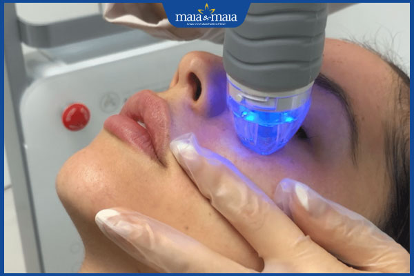 quá trình cấy da siêu vi điểm