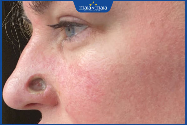 Nhận biết sớm mụn trứng cá ung và cách điều trị dứt điểm 3 rủi ro khi tự xử lý mụn ung