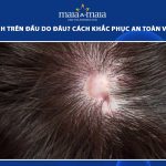 sẹo bẩm sinh trên đầu