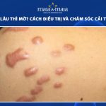 sẹo bao lâu thì mờ