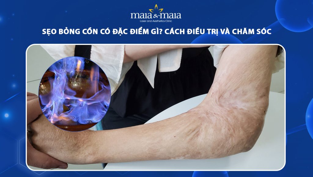 sẹo bỏng cồn