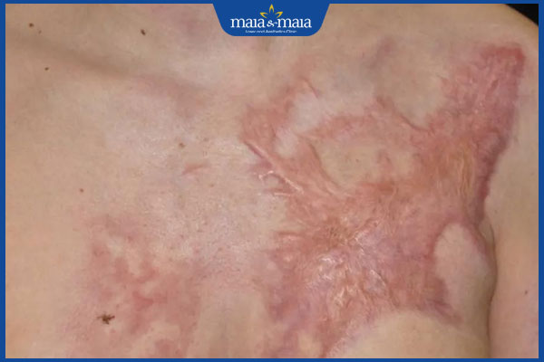 sẹo bỏng sẫm màu