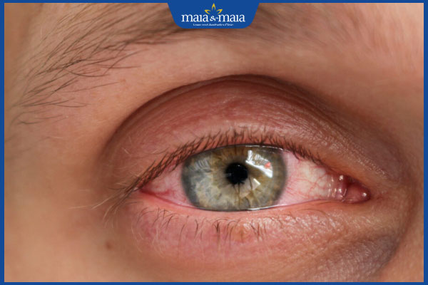 sẹo gây đau mắt