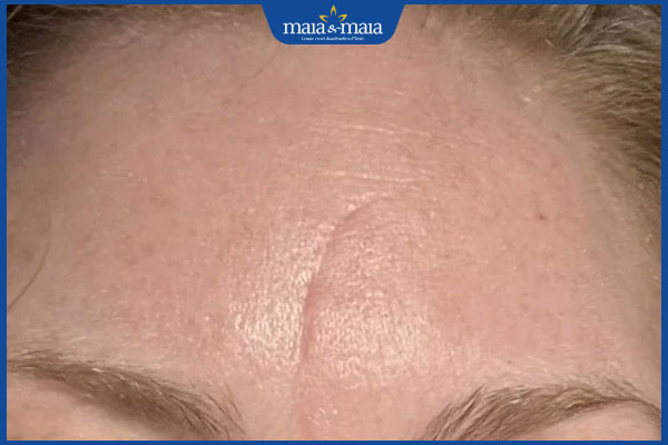 sẹo giữa ấn đường