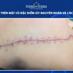 sẹo khâu trên mặt