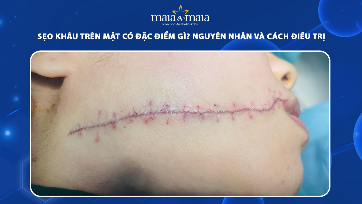 sẹo khâu trên mặt