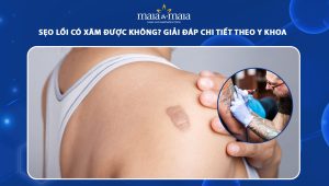 sẹo lồi có xăm được không