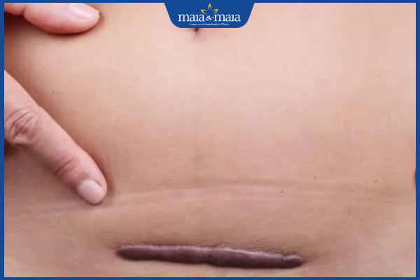 sẹo lồi sinh mổ