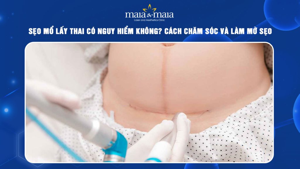 Sẹo mổ lấy thai có nguy hiểm không? Biện pháp làm mờ sẹo 1 sẹo mổ lấy thai