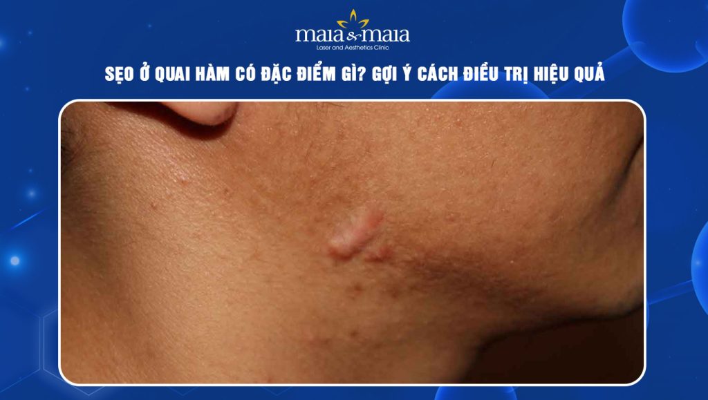 Sẹo ở quai hàm có đặc điểm gì? Gợi ý cách điều trị hiệu quả 1 sẹo ở quai hàm