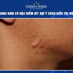 sẹo ở quai hàm