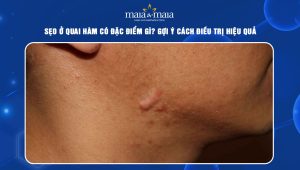 sẹo ở quai hàm