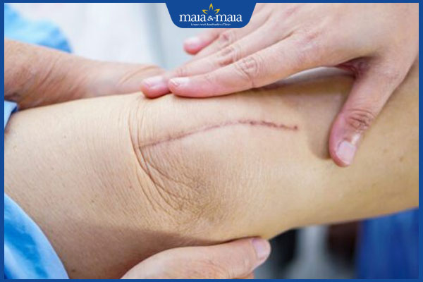 sẹo phẫu thuật