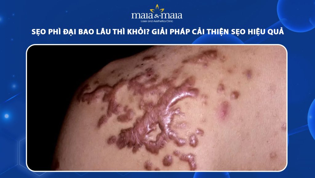 sẹo phì đại bao lâu thì khỏi