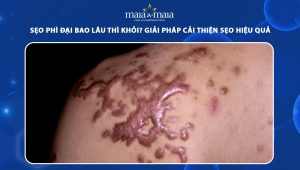 sẹo phì đại bao lâu thì khỏi