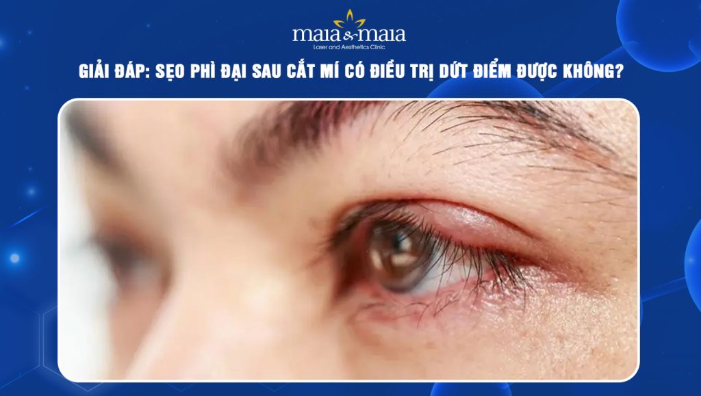 Giải đáp: Sẹo phì đại sau cắt mí có điều trị dứt điểm được không? 1 sẹo phì đại sau cắt mí