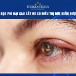 sẹo phì đại sau cắt mí