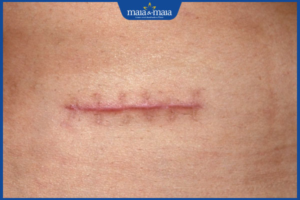 Sẹo phẫu thuật có đặc điểm gì điển hình? Lý do xuất hiện sẹo xấu 2 sẹo sẫm màu