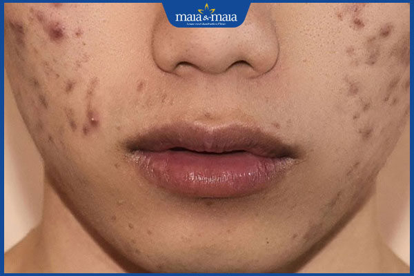 sẹo thâm sẫm màu