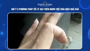 sẹo trên ngón trỏ trái