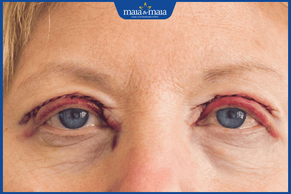 Giải đáp: Sẹo phì đại sau cắt mí có điều trị dứt điểm được không? 2 sẹo xấu sau cắt mí