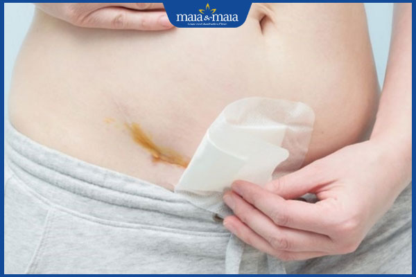 Sẹo mổ lấy thai có nguy hiểm không? Biện pháp làm mờ sẹo 3 thay băng vết mổ