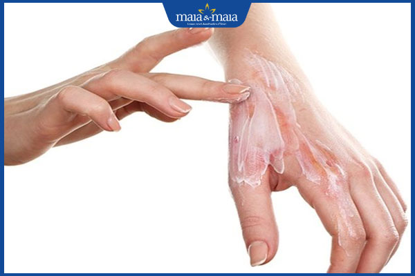 thoa kem trị sẹo bỏng