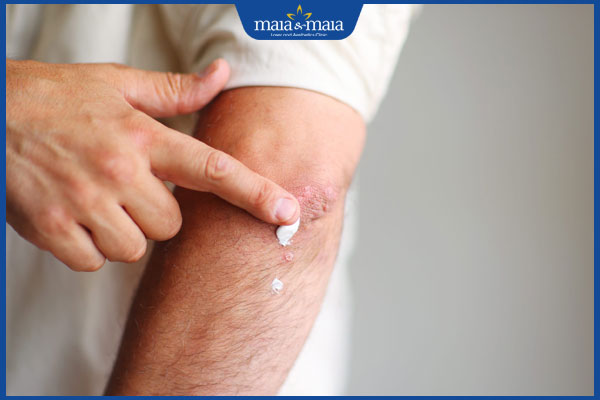 thoa kem trị sẹo thâm đỏ