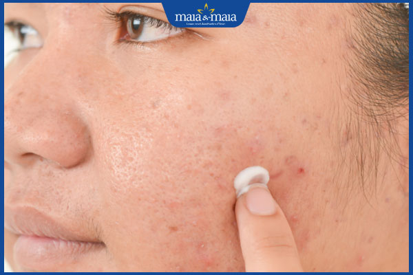 Mụn trứng cá ở má do đâu? Cách điều trị và chăm sóc da 3 thoa thuốc trị sẹo mụn