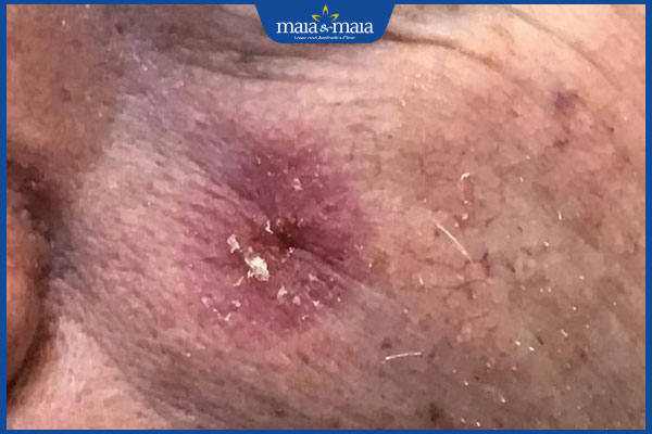 Nhận biết sớm mụn trứng cá ung và cách điều trị dứt điểm 2 tình trạng mụn trứng cá ung